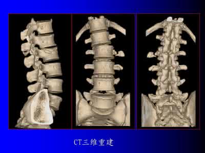 中国脊柱脊髓 【PPT】脊柱和脊髓病变MRI诊断（一）