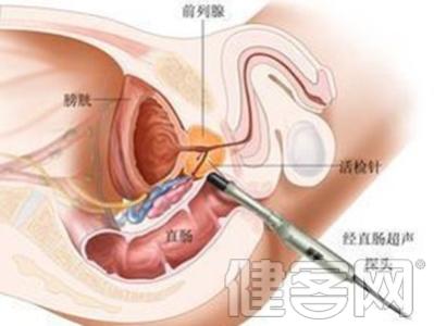 前列腺癌危险因素等级 如何预防前列腺癌 管好5个因素就可以