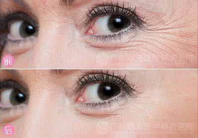 打针去鱼尾纹多少钱 打针去鱼尾纹成“阴阳眼” 专家称这是“玩命”