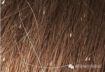 怎样预防猫咪长虱子 头上长虱子图片 头上长虱子怎么办 如何有效预防虱子