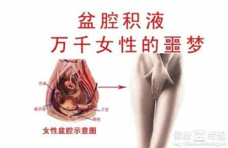 盆腔积液是什么疾病 身体为何有积液（疾病探秘）