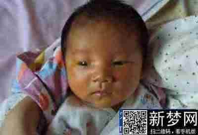 新生儿黄疸怎么回事 新生儿黄疸多怎么办 新生儿黄疸是怎么回事