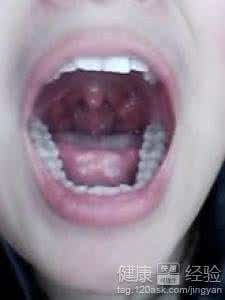 孕妇牙龈发炎 孕妇牙龈发炎 孕妇牙龈发炎有什么药？