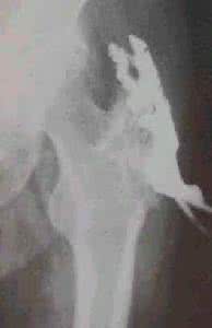 骨结核的治疗方法 骨结核 什么叫骨结核？