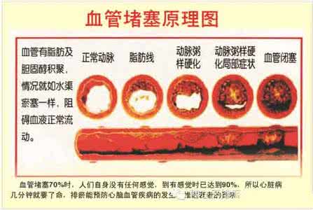 全身血管堵塞 转载 治疗全身各部位血管堵塞中药方