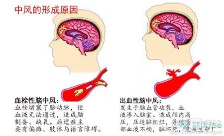 治疗脑血栓最好的药 脑血栓能治好吗 脑血栓的治疗与饮食