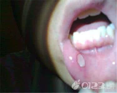 口腔溃疡的早期症状 口腔溃疡的早期症状 口腔溃疡是如何引起的