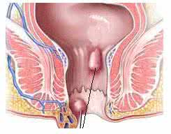 肛门瘙痒湿疹用药 肛门湿疹瘙痒