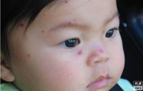 长水痘怎么止痒 宝宝长水痘怎么护理_宝宝长水痘怎么止痒