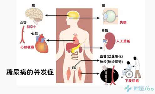 老年人糖尿病并发症 糖尿病并发症 糖尿病并发症一般几年