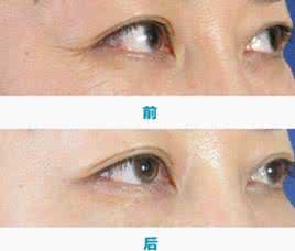 鱼尾纹除皱手术 详图细解:详解手术去鱼尾纹的优点