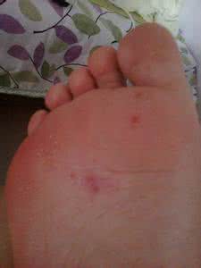 治脚癣用什么药膏最好 脚癣怎么治