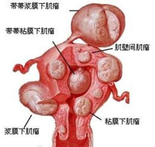 子宫肌瘤的症状是什么 子宫肌瘤的症状有什么 子宫肌瘤的症状是什么