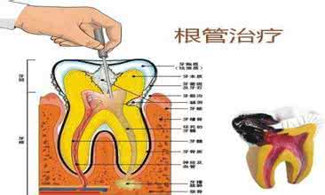 乳牙磨牙 乳牙大面积缺损修复 HALL技术结合Carisolv修复乳磨牙大面积缺损的临床研究