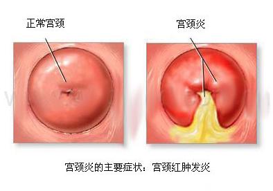 急性宫颈炎的病因 急性宫颈炎 急性宫颈炎的病因是什么