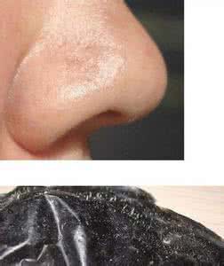 去黑头产品排行榜 选对去黑头产品 让你跟黑头说再见