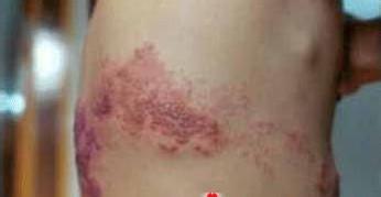 病毒性带状疱疹的治疗 今年的带状疱疹很毒 是变异了