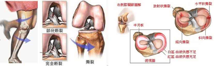 膝关节的半月板损伤 膝关节半月板损伤 半月板损伤的原因