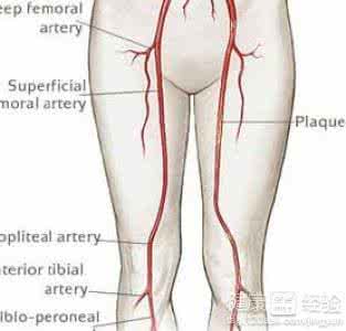 下肢动脉硬化如何治疗 下肢动脉硬化的治疗 如何治疗下肢动脉硬化