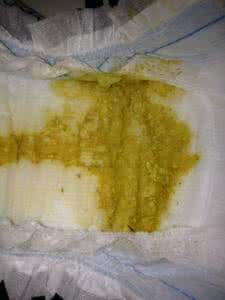 宝宝一天没拉大便 50天宝宝一天没大便 50天的宝宝一天拉几次大便才好