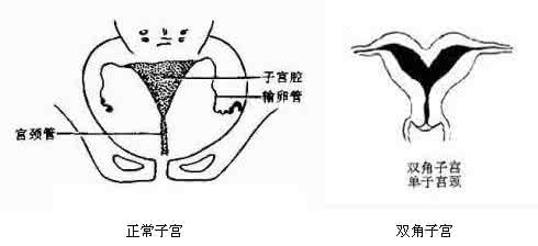 双角子宫形成的原因 双角子宫是怎么形成的？