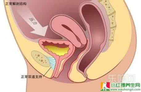 治疗尿失禁的偏方 压力性尿失禁治疗方法