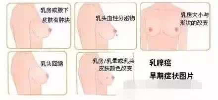 乳腺癌的前兆 乳腺癌:最常见的前兆表现