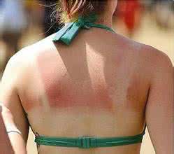 皮肤晒伤了怎么办 夏季皮肤晒伤了怎么办