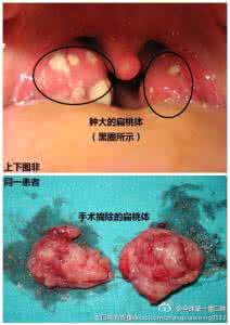 扁桃体一侧肿大的危害 一侧扁桃体肿大怎么办