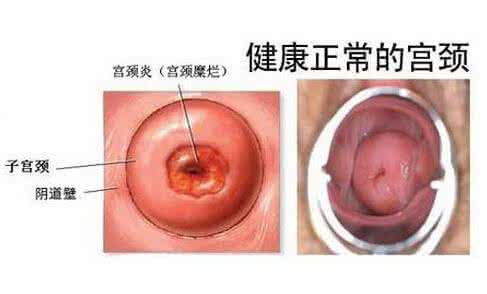 宫颈炎的症状用什么药 宫颈炎的症状