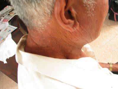 带状疱疹后遗神经痛药 带状疱疹后遗神经痛  多种方法治疗它