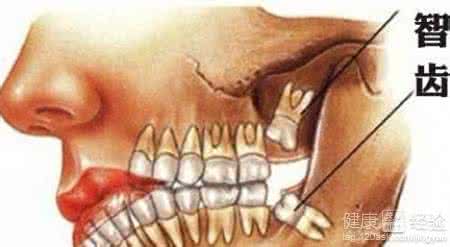 智齿拔下巴永久没知觉 拔智齿导致下巴无知觉 下巴疼是怎么回事 这些原因导致你的下巴疼