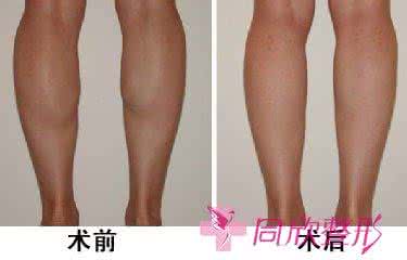 瘦腿针能打大腿吗 瘦腿针可以瘦大腿吗 瘦腿针真的可以瘦大腿吗?