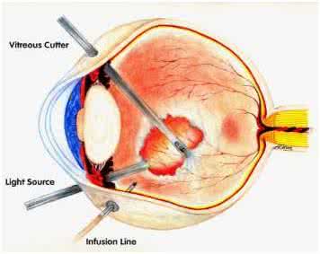 眼底病最好治疗方法 眼底病治疗 眼底病的治疗方法有哪些