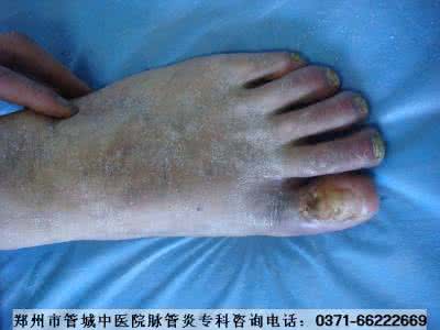 脉管炎早期症状图片 血栓闭塞性脉管炎 血栓闭塞性脉管炎的症状