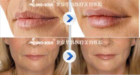 注射玻尿酸除皱多少钱 注射玻尿酸除皱多少钱 注射玻尿酸除皱多少钱