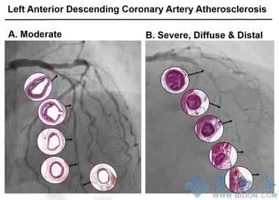 重症心脏病 重症心脏病的生物标志物新发现