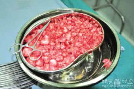 三味中药治黄褐斑 三味中药便可轻松击溃子宫肌瘤