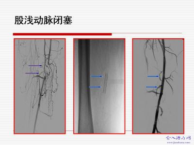 下肢动脉血管闭塞症 【强力推荐】老方新验--治下肢动脉闭塞症的经验方-