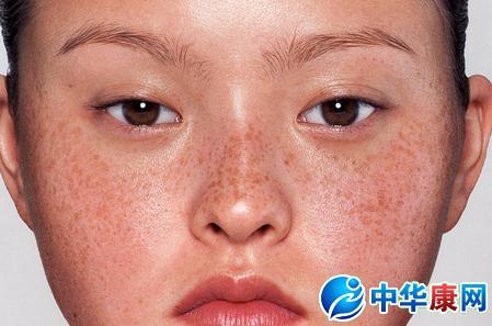 如何去除雀斑黄褐斑 哪里去除雀斑最好 如何治黄褐斑
