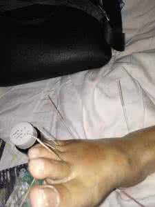 阴阳九针导龙入海 阴阳九针 阴阳九针第三针——导龙入海