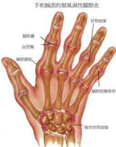 手指关节疼痛的原因 手指关节疼痛的原因 手指关节疼痛的原因-手指关节疼痛的危害