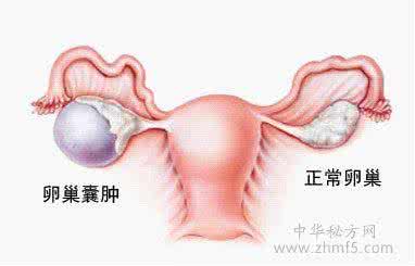 什么是卵巢囊肿 什么是卵巢囊肿 全面认识卵巢囊肿