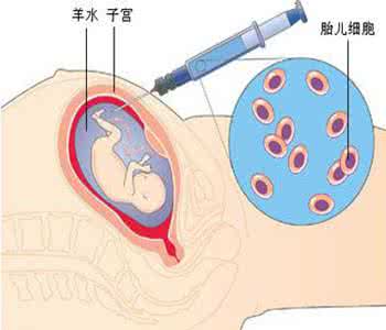 羊水穿刺有什么副作用 羊水穿刺有风险吗