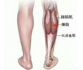腓肠肌痉挛 徒手治腓肠肌痉挛