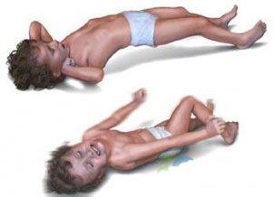 小儿惊厥能自愈吗 小儿惊厥