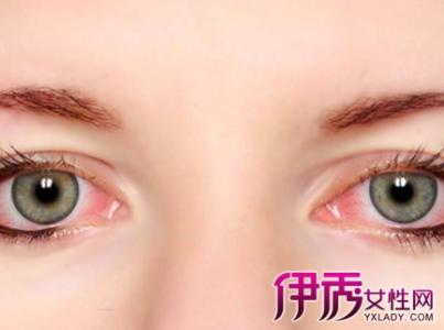 眼睛红血丝怎么消除 眼睛红血丝怎么消除 眼睛里面有红血丝的正确消除方法