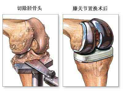 膝关节外翻 专题教程：外翻膝关节的关节置换术