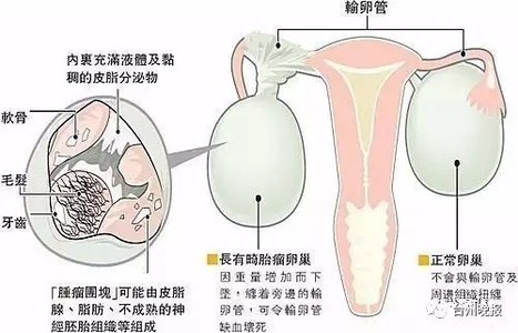 卵巢畸胎瘤影响生育吗 子宫结节影响怀孕吗? 卵巢畸胎瘤影响怀孕吗？