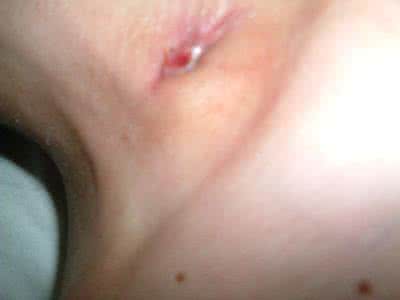 结核性淋巴结炎 结核性淋巴结炎 如何治疗结核性淋巴结炎